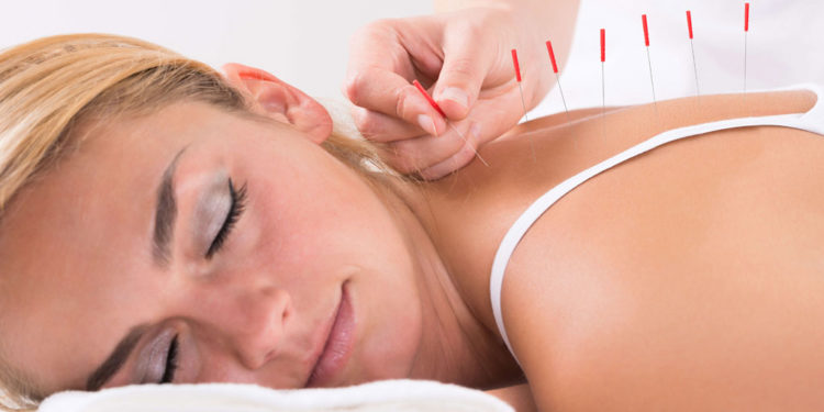 beneficios da acupuntura